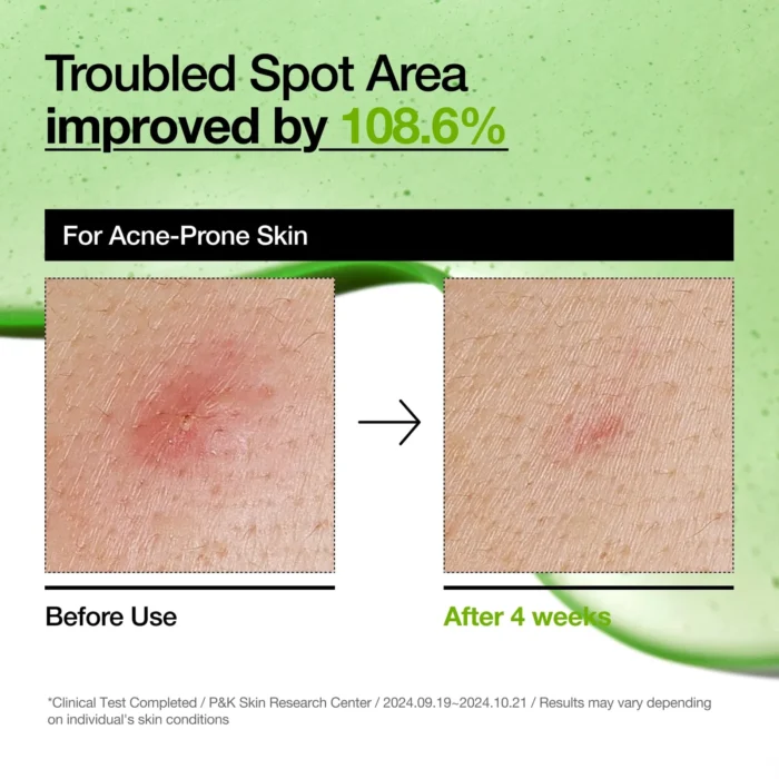 ANUA Azelaic Acid 10 Hyaluron Redness Soothing Serum 30ml - Image 4